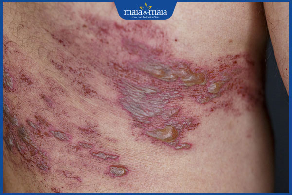 nhiễm trùng do zona