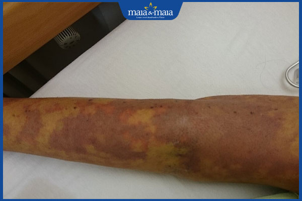 nhiễm trùng huyết