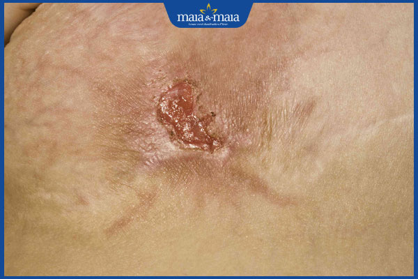 Nhiễm trùng da do vi khuẩn có nguy hiểm không? Cách điều trị 5 nhiễm tụ cầu vàng kháng Methicillin