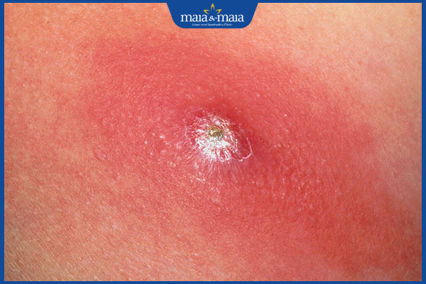 Bệnh viêm da tụ cầu do đâu? Cách điều trị như thế nào? 2 nhọt viêm da tụ cầu