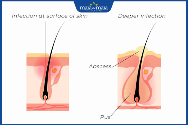 Tổng hợp các loại viêm nang lông phổ biến và cách chẩn đoán chính xác 2 phân loại viêm nang lông