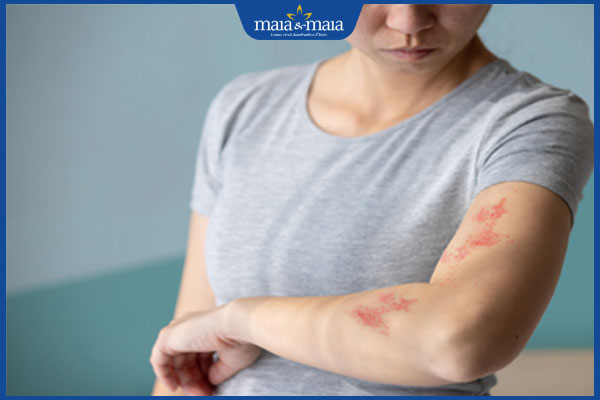 phụ nữ bị zona