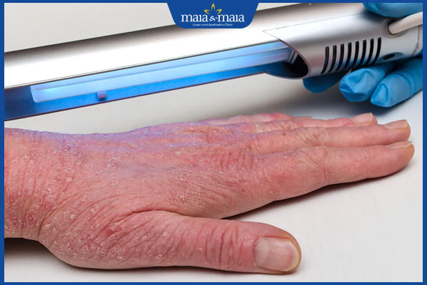 quang trị liệu trị viêm da thần kinh