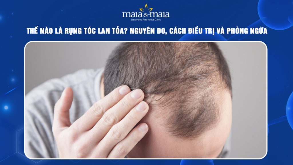 Rụng tóc lan tỏa