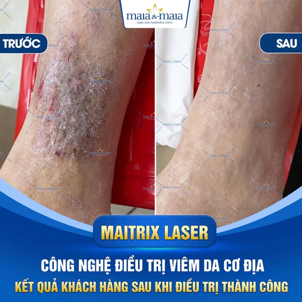 sau điều trị viêm da cơ địa