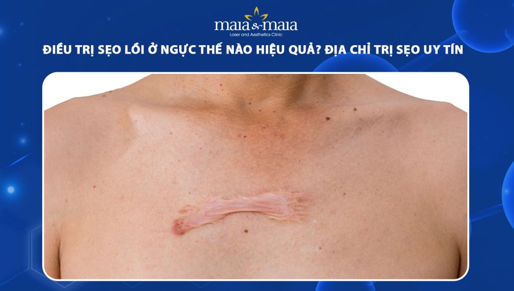 sẹo lồi ở ngực