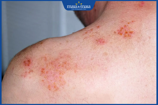 tầm quan trọng của chế độ kiêng khem khi bị zona