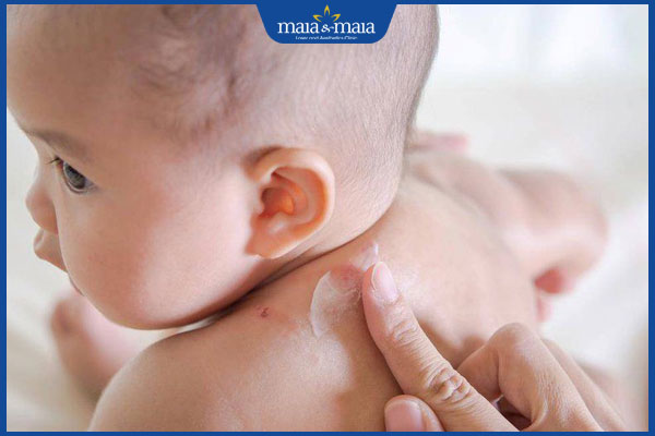 Nhiễm trùng da ở trẻ sơ sinh: Nguyên nhân và cách điều trị 5 thoa thuốc cho trẻ