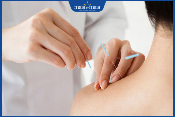 thực hiện châm cứu