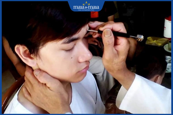 Chữa viêm da cơ địa bằng diện chẩn có tốt không? 3 thực hiện diện chẩn