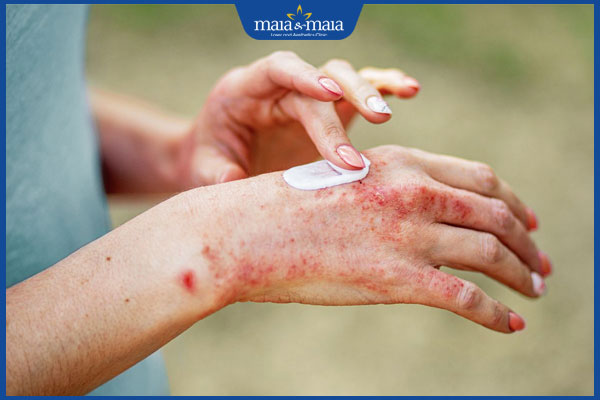 thuốc bôi viêm da bàn tay