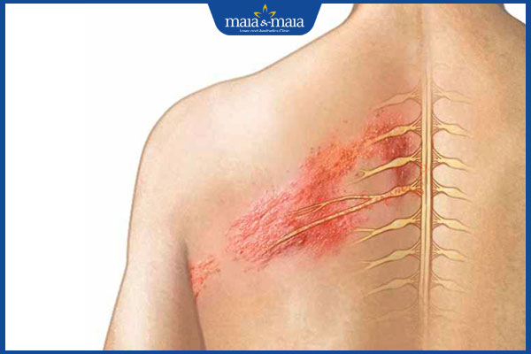 tình trạng đau thần kinh sau zona