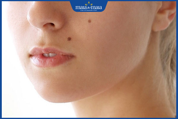 8 nốt ruồi xấu trên mặt phụ nữ và cách loại bỏ hiệu quả 2 tình trạng mọc nốt ruồi