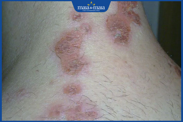 Nhiễm trùng da do vi khuẩn có nguy hiểm không? Cách điều trị 2 tình trạng nhiễm trùng da do vi khuẩn