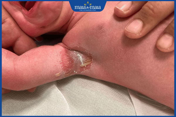 Nhiễm trùng da ở trẻ sơ sinh: Nguyên nhân và cách điều trị 2 tình trạng nhiễm trùng da ở trẻ sơ sinh