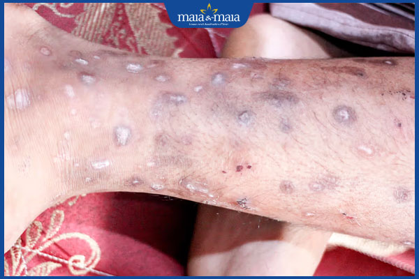 tình trạng nhiễm trùng