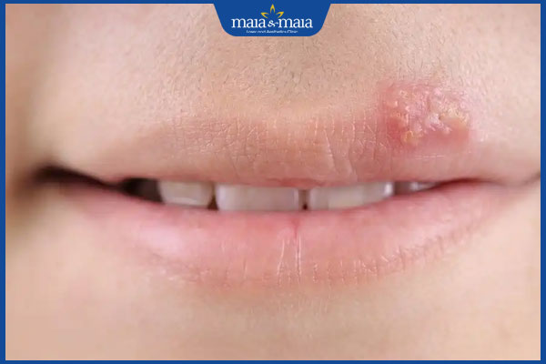 Xăm môi bị nổi mụn nước xử lý ra sao? Cách phòng tránh 2 tình trạng nổi mụn nước sau xăm môi