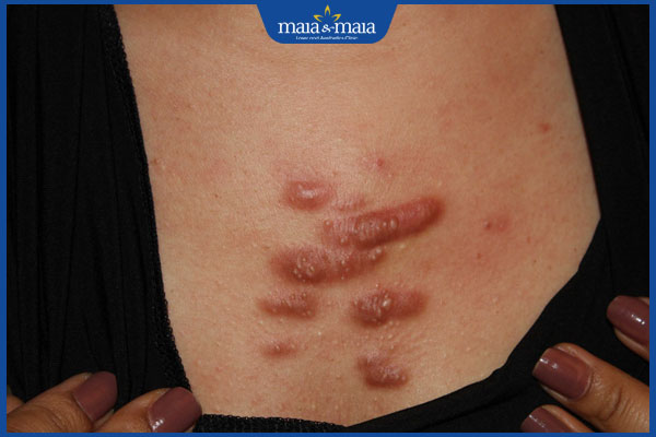 tình trạng sẹo lồi ở ngực