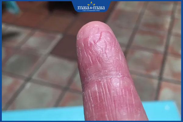 tình trạng viêm da cơ địa mất vân tay