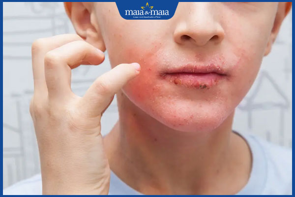 Điều trị viêm da cơ địa ở người lớn bằng công nghệ hiện đại 3 tình trạng viêm da cơ địa ở mặt