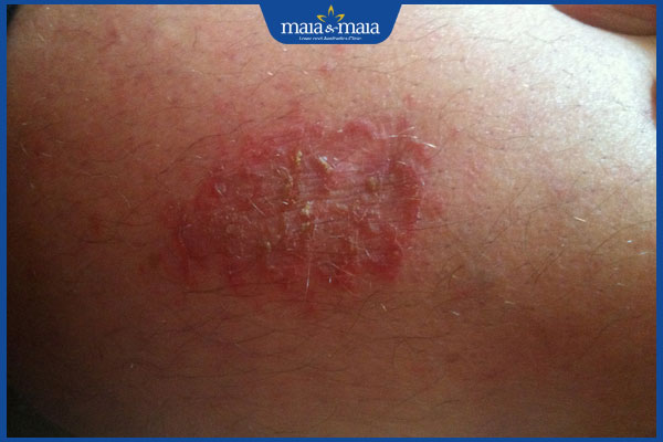 tình trạng viêm da cơ địa ở mông