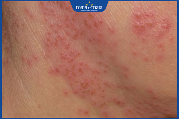 Bị viêm da cơ địa vùng kín có nguy hiểm không? 2 tình trạng viêm da cơ địa ở vùng kín