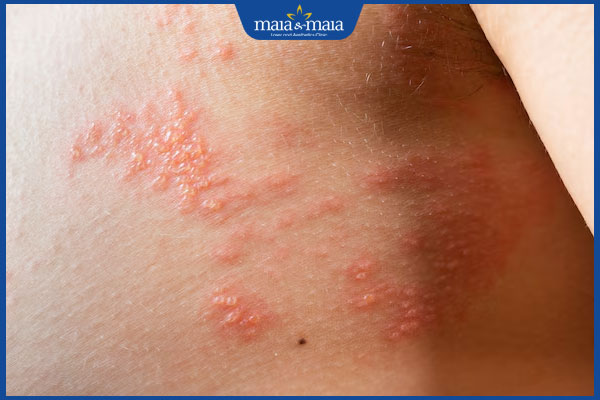 tình trạng viêm da dạng herpes