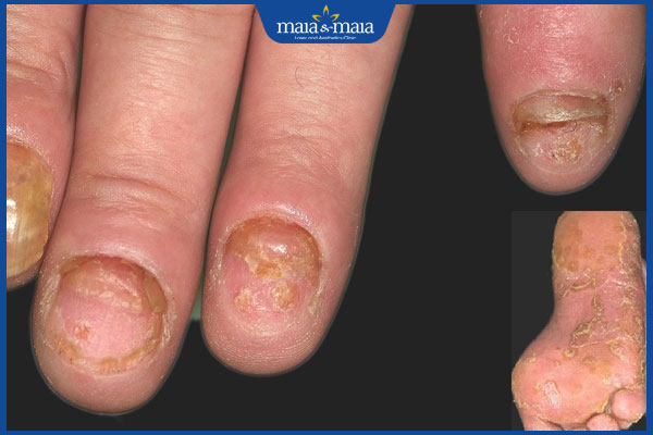 tình trạng viêm da đầu chi liên tục