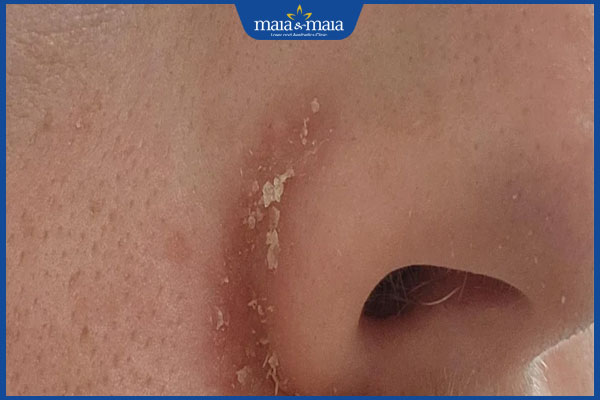 tình trạng viêm da dầu ở cánh mũi