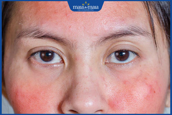 Hướng dẫn chăm sóc cho người bị viêm da dầu hàng ngày 2 tình trạng viêm da dầu