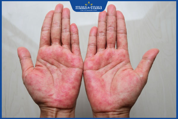 tình trạng viêm da dị ứng ở bàn tay