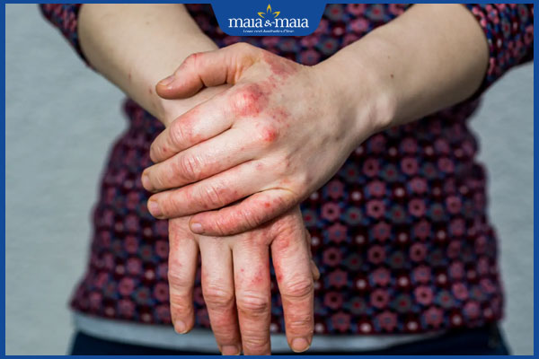 tình trạng viêm da dị ứng