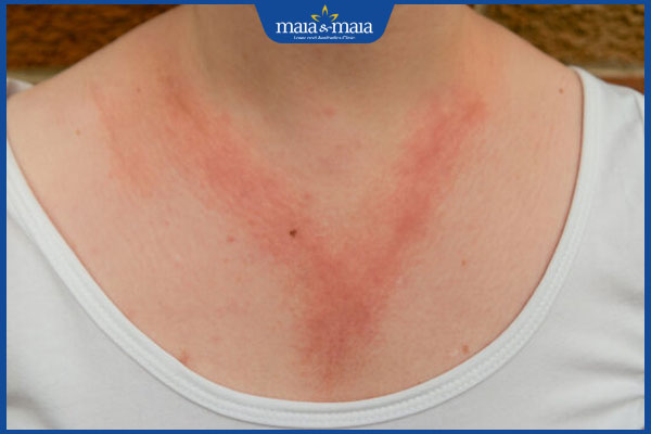 tình trạng viêm da do tiếp xúc ánh sáng