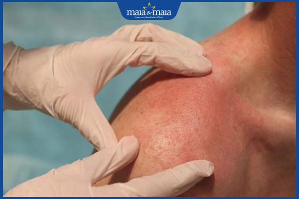 tình trạng viêm da kích ứng ánh sáng