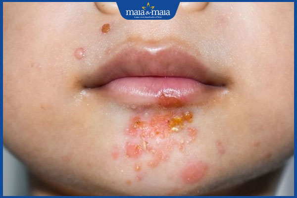 tình trạng viêm da liên cầu