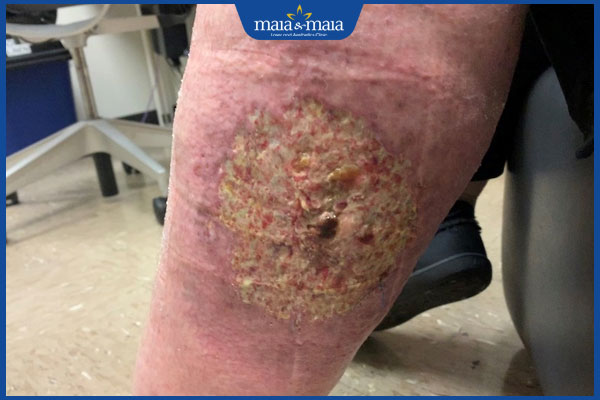 tình trạng viêm da mủ nặng