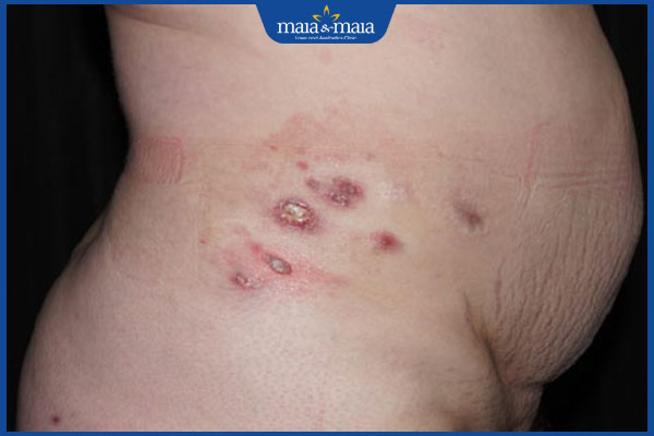 Tổng hợp danh sách 8 loại thuốc bôi trị viêm da mủ hiệu quả 2 tình trạng viêm da mủ