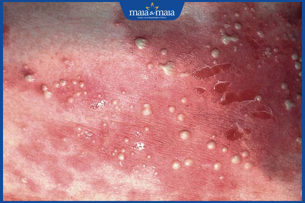 tình trạng viêm da mụn mủ dưới lớp sừng