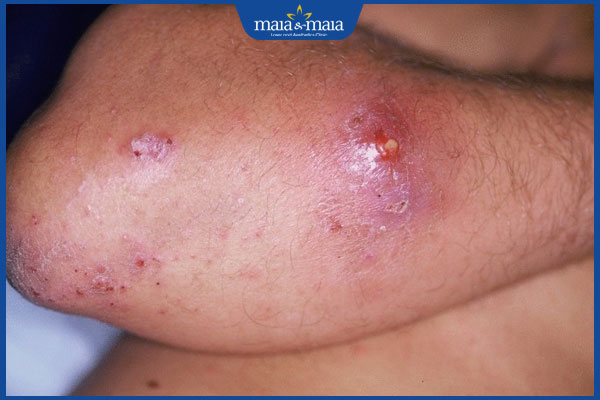 tình trạng viêm da nhiễm trùng