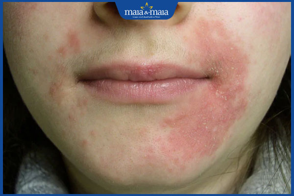 tình trạng viêm da ở quanh miệng