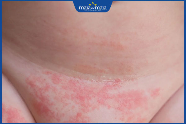 Bệnh viêm da: Nguyên nhân và cách điều trị hiệu quả 3 tình trạng viêm da tã lót ở trẻ em