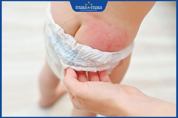 Viêm da đầu chi ruột là gì? Nguyên nhân và cách điều trị 4 tình trạng viêm da tã lót
