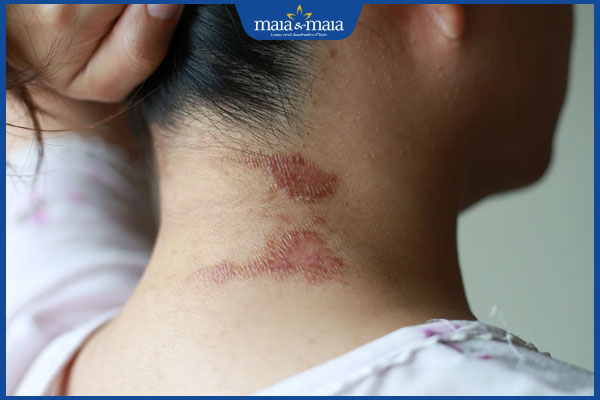 Bệnh viêm da: Nguyên nhân và cách điều trị hiệu quả 7 tình trạng viêm da thần kinh
