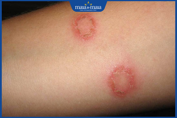 Viêm da thể đồng tiền là gì? Cách chẩn đoán và điều trị 2 tình trạng viêm da thể đồng tiền