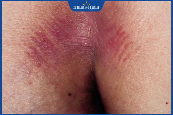 tình trạng viêm da tiếp xúc ở vùng kín