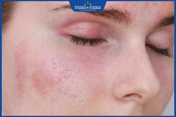 tình trạng viêm da tiếp xúc