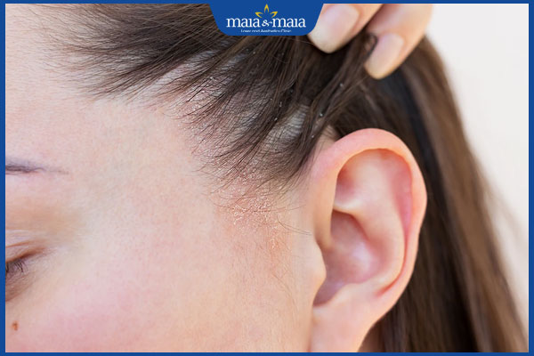 tình trạng viêm da tiết bã