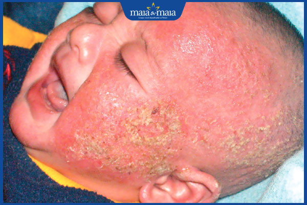tình trạng viêm da tụ cầu ở trẻ