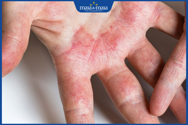 tình trạng viêm da