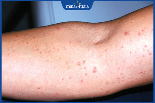 tình trạng viêm lỗ chân lông ở tay